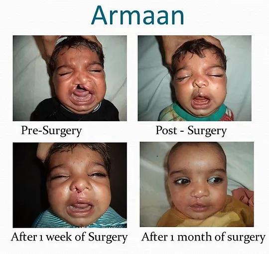 Pre-Surgery & Post-Surgery