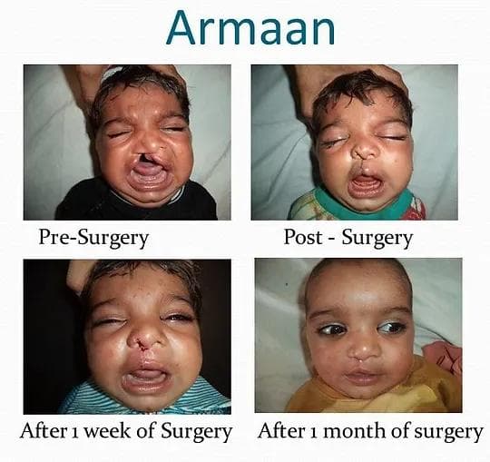 Pre-Surgery & Post-Surgery