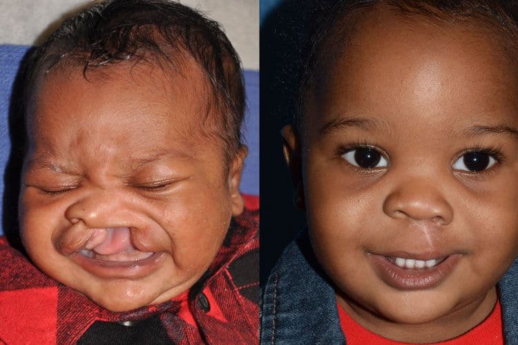 Rebuilding Lives Through Free Cleft Surgeries