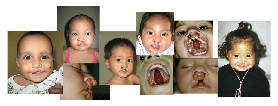 kids with Cleft Lip & Palate